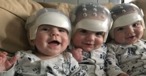 Nati con una rara condizione cranica 3 gemelli dopo un trattamento speciale ora stanno crescendo benissimo