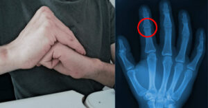 Cosa accade quando si “scrocchiano” le dita? Ecco la verità!