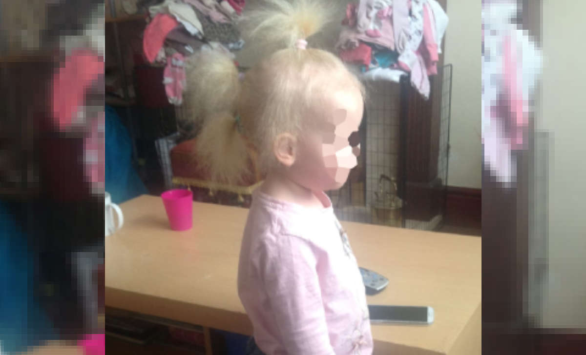Una bambina soffre di una strana sindrome dei capelli che le impedisce