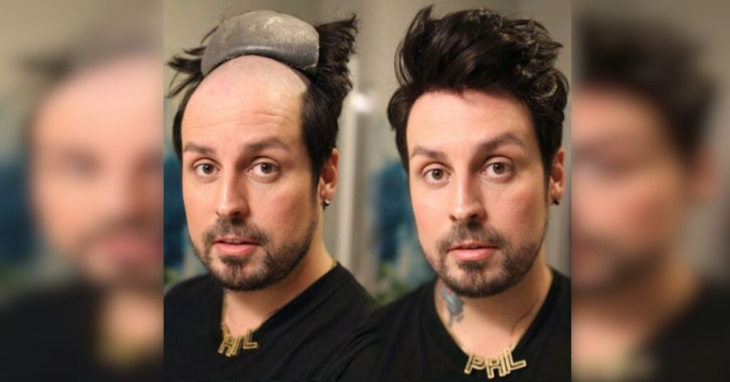 17 uomini trasformati dopo un trapianto di capelli. Il prima e il dopo