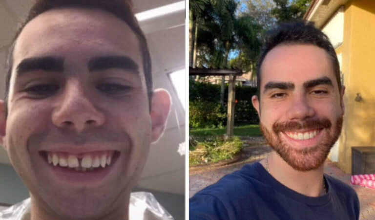 Un giovane subisce nove interventi chirurgici per trasformare il suo volto e mostra la sua trasformazione su TikTok Un giovane subisce nove interventi chirurgici per trasformare il suo volto e mostra la sua trasformazione su TikTok