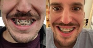 14 persone che hanno condiviso la trasformazione del sorriso dopo le sedute dal dentista
