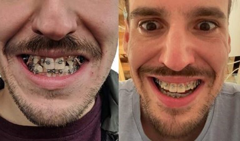 14 persone che hanno condiviso la trasformazione del sorriso dopo le sedute dal dentista 14 persone che hanno condiviso la trasformazione del sorriso dopo le sedute dal dentista