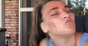 15 persone che hanno provato sulla propria pelle quanto il sole sa essere spietato
