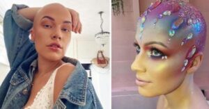 La giovane soffre di alopecia da quando aveva 17 anni ed è stata presa in giro, ma la sua vita è cambiata
