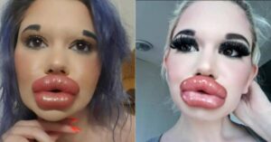 La donna con le labbra più grandi del mondo che vuole sembrare una Barbie, Che trasformazione dalla prima FOTO