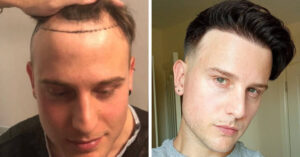 15 foto prima e dopo di persone che hanno deciso di correggere il proprio aspetto con la chirurgia plastica