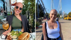 La donna derisa sin dalla sua adolescenza per aver sofferto di alopecia condivide il modo in cui lo ha affrontato