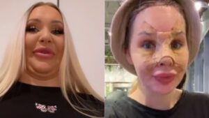 Il prima e dopo di una giovane donna che ha speso migliaia di dollari per sembrare una bambola Barbie